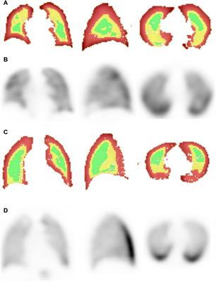 SPECT/CT to quantify early small airway disease and its relationship to clinical symptoms in smokers with normal lung function: a pilot study